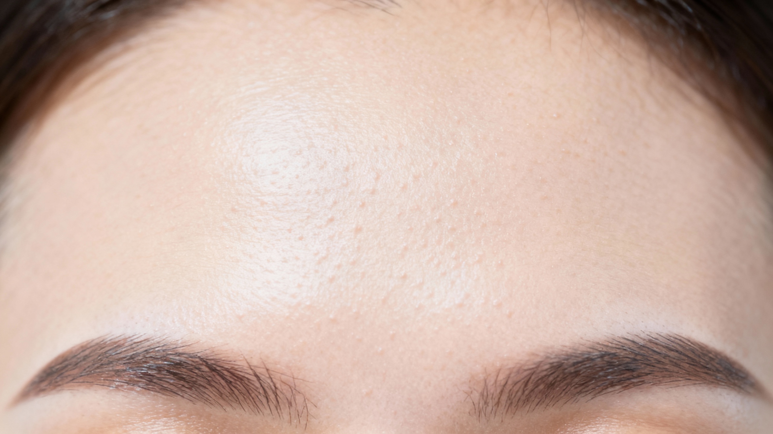 Featured image for What causes forehead acne?